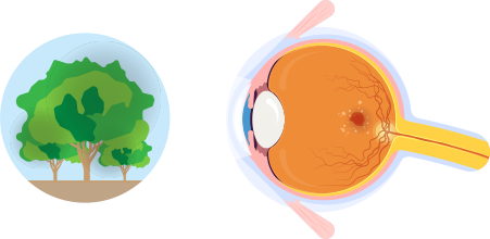 濕性黃班病變導致視野缺損的視覺圖