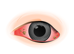 眼睛異物感為結膜炎症狀