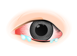 流眼水為結膜炎症狀
