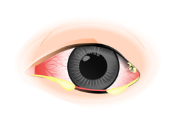 眼睛分泌物為結膜炎症狀