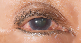 角膜混濁為先天性青光眼症狀表現