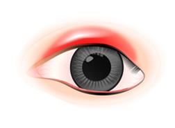 眼瞼紅腫為結膜炎症狀