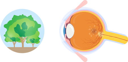 乾性黃斑病變導致視力模糊的視覺圖
