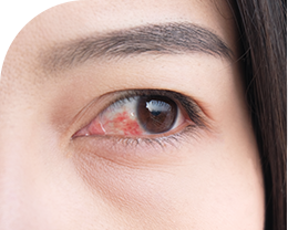 眼睛發炎為視網膜脫落原因
