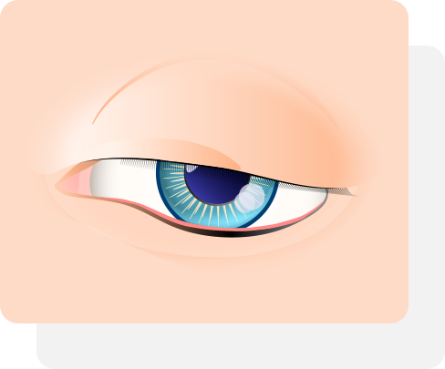 進行眼整形前的眼瞼下垂狀況
