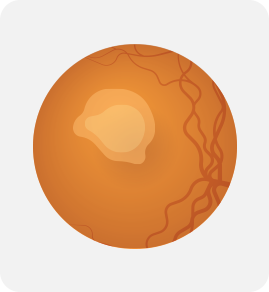 視網膜母細胞瘤為眼腫瘤之一