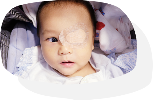 戴眼罩的幼童接受先天性弱視治療
