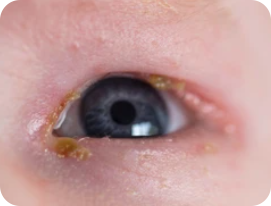 眼睛分泌物為眼臉炎症狀