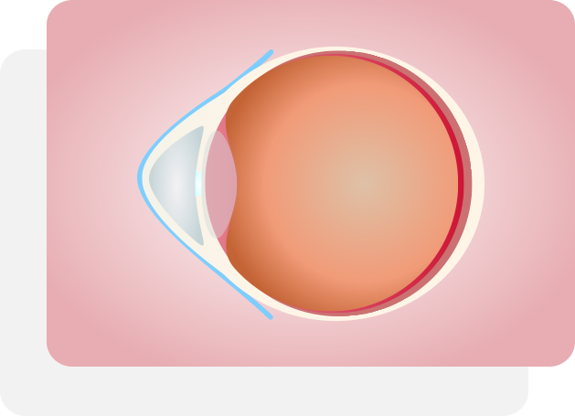 錐形角膜眼睛結構
