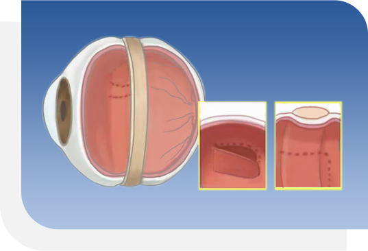 視網膜脫落手術_鞏膜扣壓術前後對比