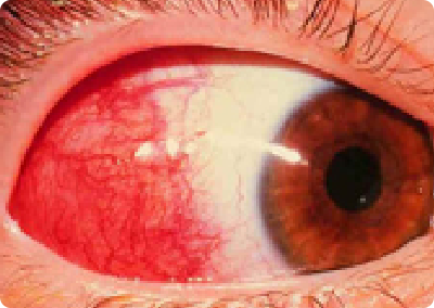 眼紅為單純性表層鞏膜炎症狀表現
