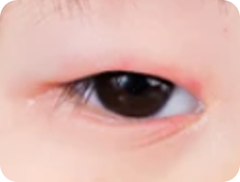 眼臉紅腫為眼臉炎症狀