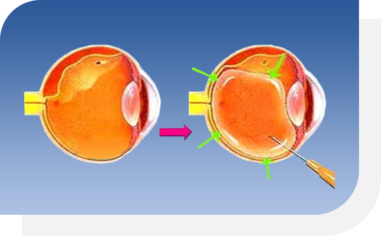視網膜脫落手術_氣體網膜固定術手術過程