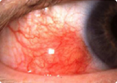眼紅為結節性表層鞏膜炎症狀表現