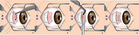 斜視矯正眼科手術步驟及過程