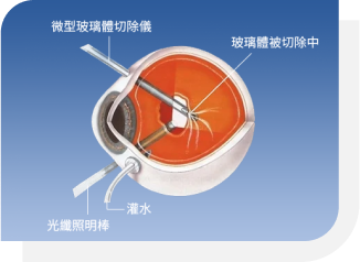 視網膜脫落手術_玻璃體切除術操作過程