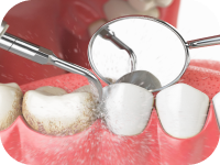 清除牙結石及牙菌膜