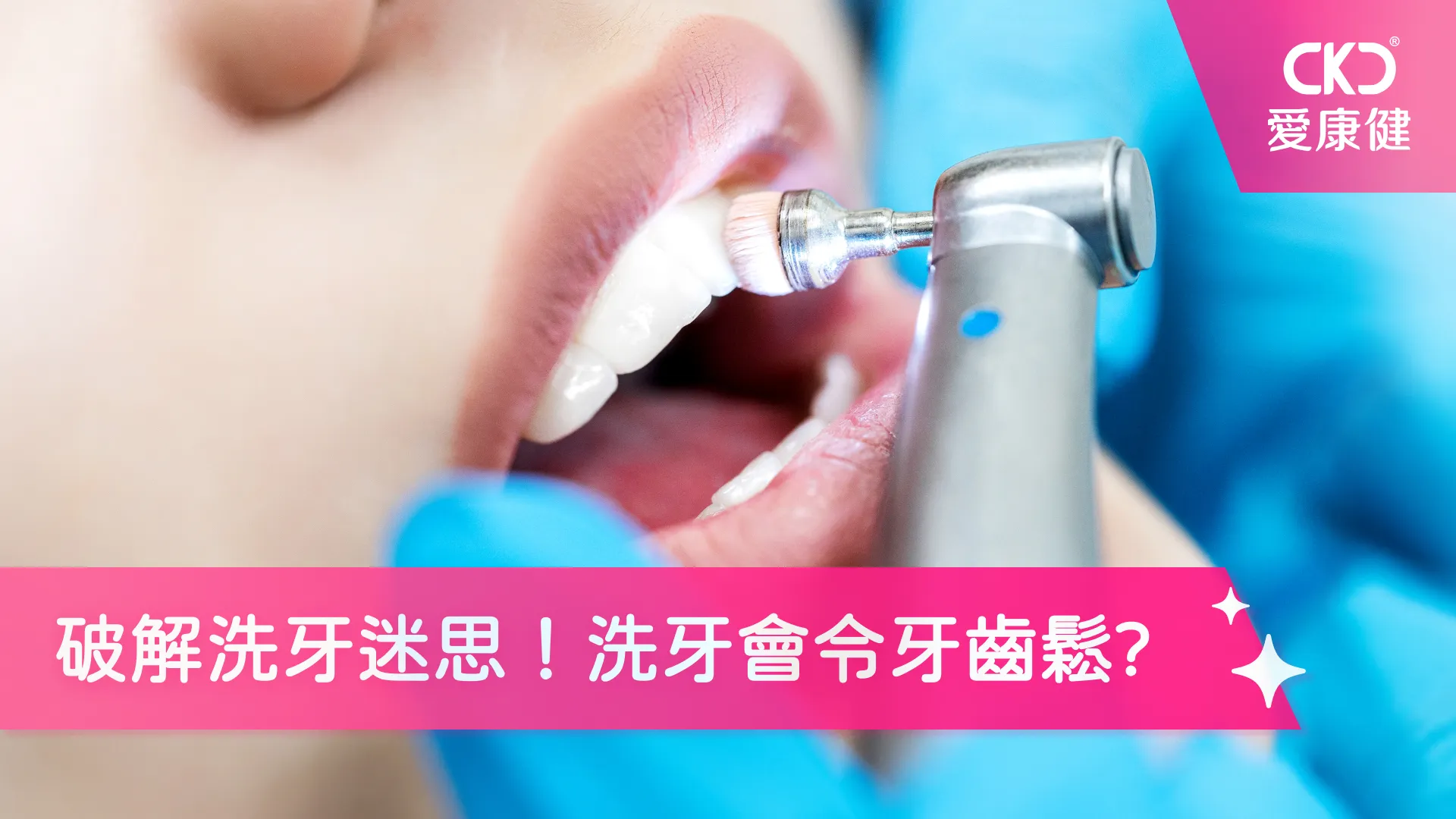 破解洗牙迷思！洗牙會令牙齒鬆?