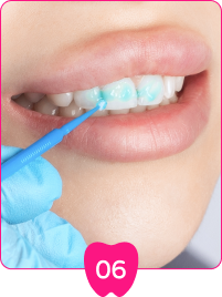 在牙齒表面均勻塗上激光專用美白劑