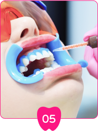 在牙齦塗上牙齦保護劑，以免激光及美白劑刺激牙齦