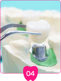 在等待永久牙冠製作期間，可能會安裝臨時牙冠保護牙齒。
