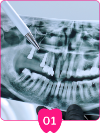 由我們的牙醫為您進行口腔X Ray檢查並診斷，建議適合您的治療方案。