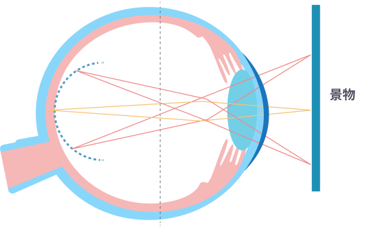 角膜矯形產生的周邊離焦