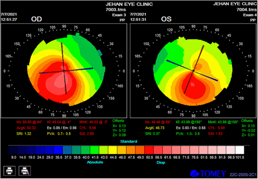 ZEISS Vision Expert