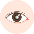 pages.medical_service.cataract