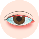 眼科服務_眼角膜疾病